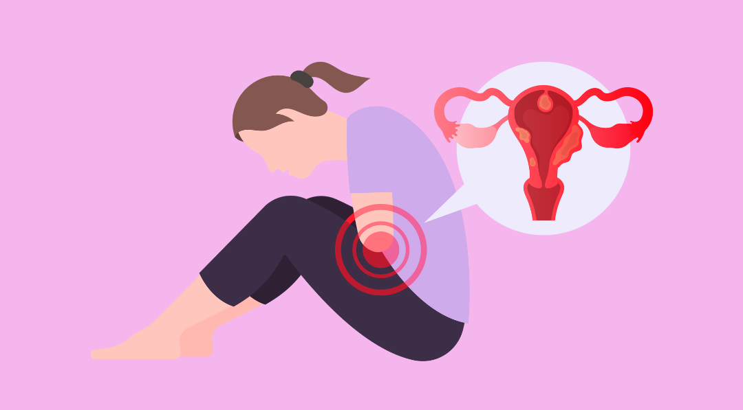 SOPK ou endométriose : quelles différences (et peut-on avoir les deux) ?